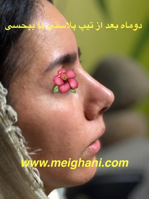 جراحی تیپ پلاستی با بی حسی