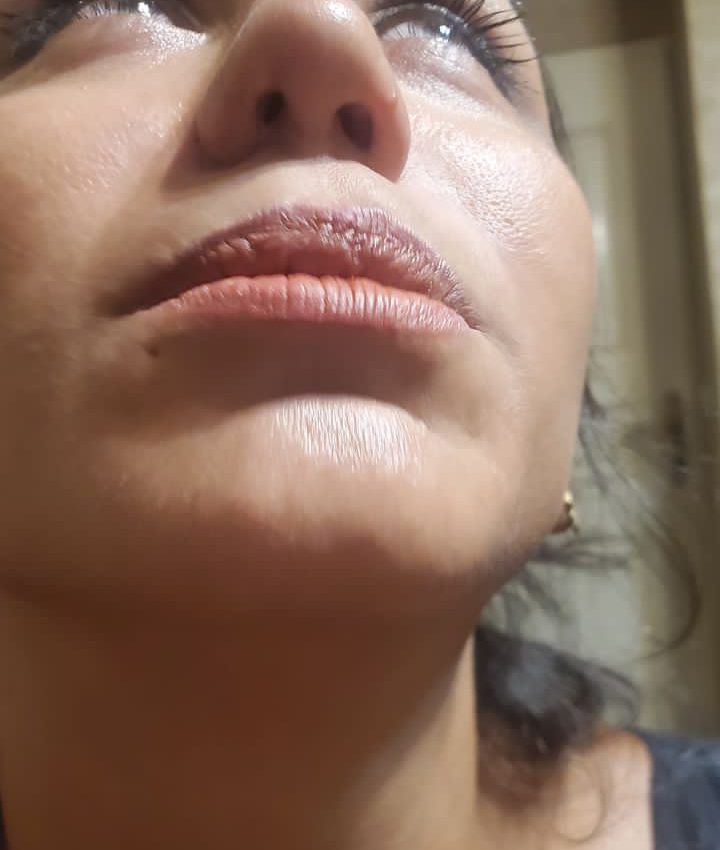 جراحی ترمیمی باز کردن حفره های بینی با استفاده از غضروف گوش (قبل)